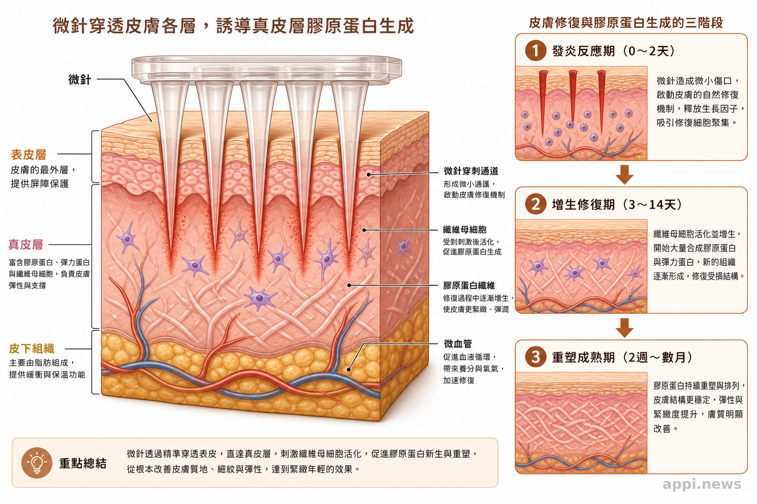 微針穿透皮膚各層、誘導真皮層膠原蛋白生成的截面示意圖
