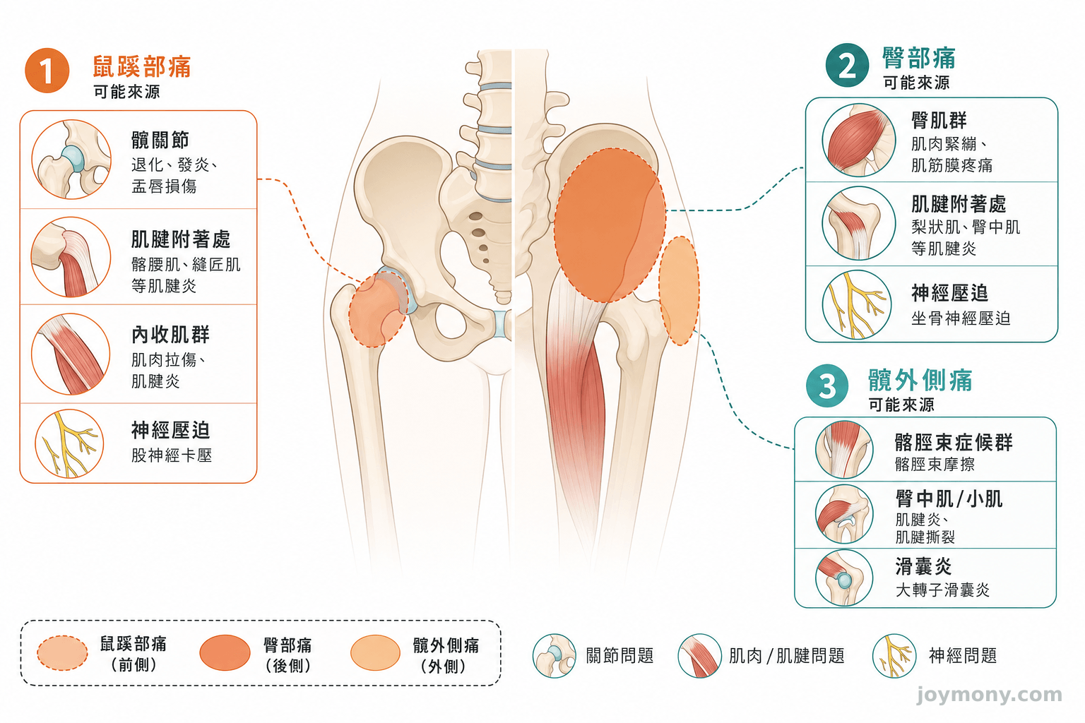 髖部疼痛三個常見位置（鼠蹊部、臀部、髖外側）對應可能來源示意圖